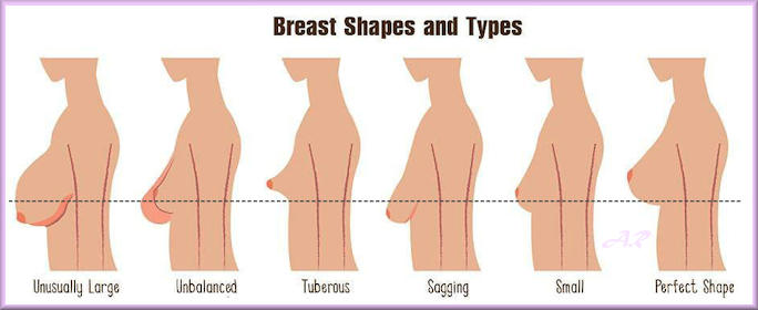Second Type Woman - Breast Augmentation