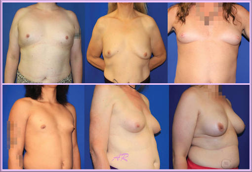 Developing Shemale Tits - Second Type Woman - Breast Development