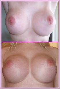 Second Type Woman - Breast Augmentation